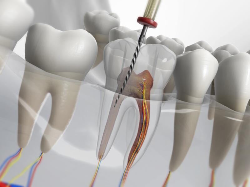 علاج قناة الجذر