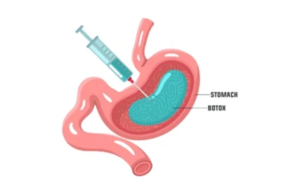 بوتوكس المعدة