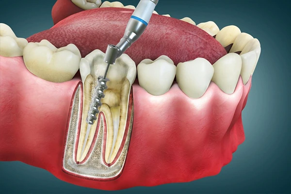 علاج جذور الاسنان