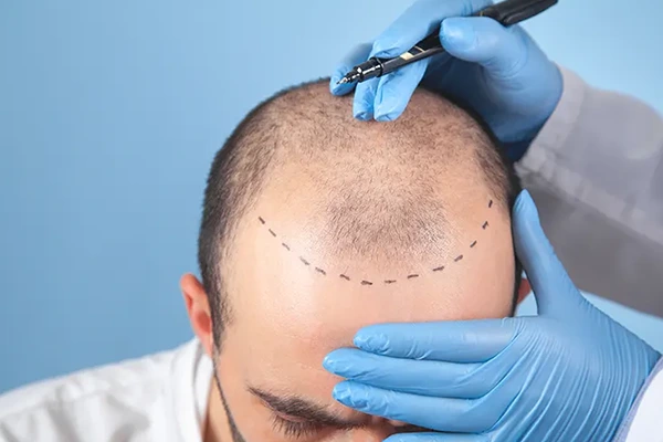 زراعة الشعر بتقنية الاقتطاف (FUE)