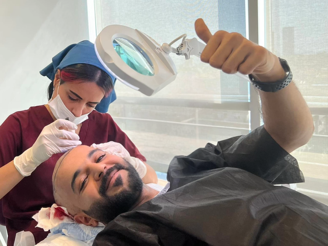 زراعة الشعر لدى الرجال