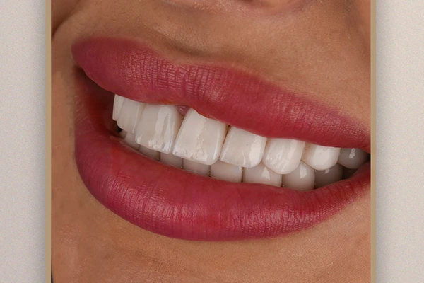 فينير بتصميم طبيعي