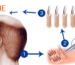 زراعة الشعر بتقنية FUE