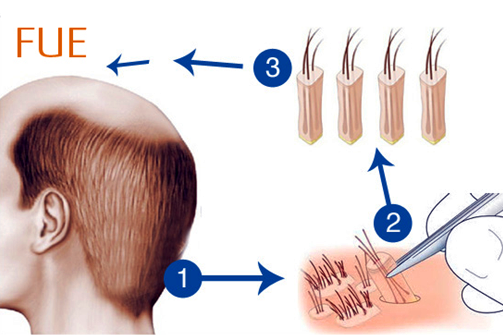 زراعة الشعر بتقنية FUE