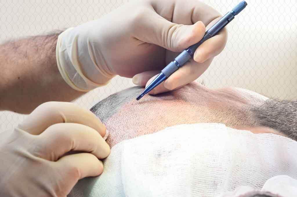 زراعة الشعر بتقنية السفير في تركيا