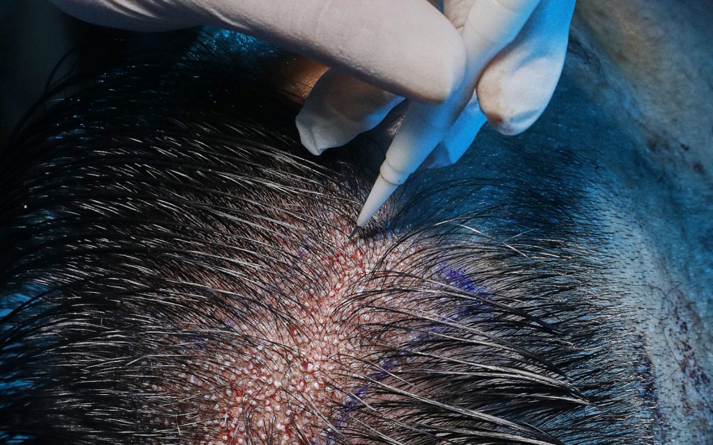 زراعة الشعر بدون حلاقة