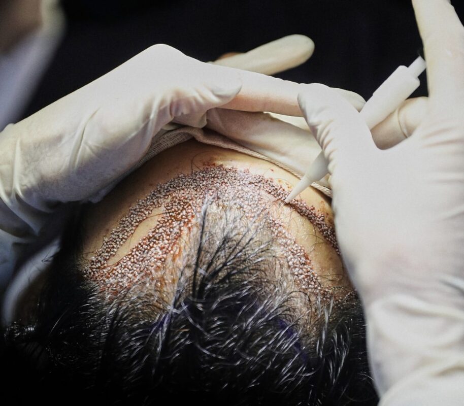 زراعة الشعر في إسطنبول