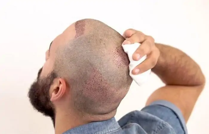 ما بعد عملية زراعة الشعر