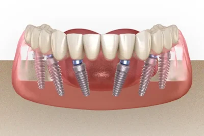 أفضل أنواع زرعات الأسنان