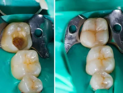حشوات الأسنان التجميلية