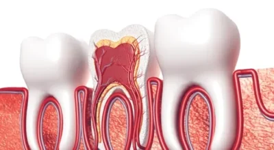 علاج جذور الاسنان​