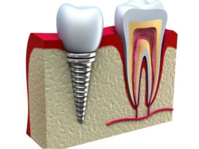 Dental Implants