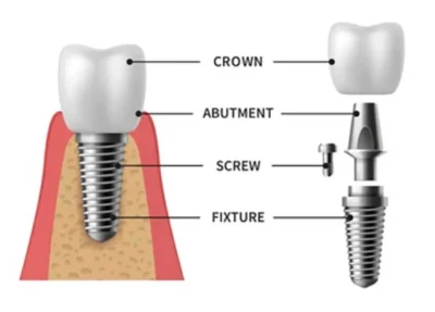 Dental Implants
