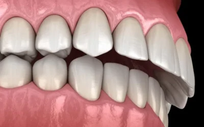 Crooked Teeth