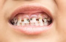 Rotten Teeth