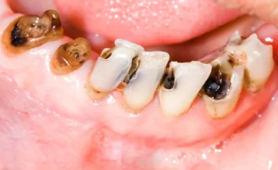 Rotten teeth