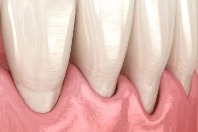 Gum Health