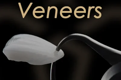 composite veneers