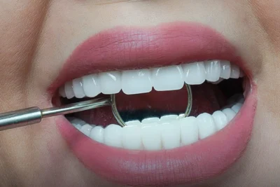 perfect smile