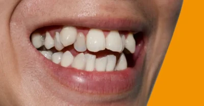 Crooked Teeth