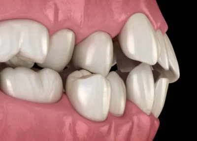 Crooked Teeth
