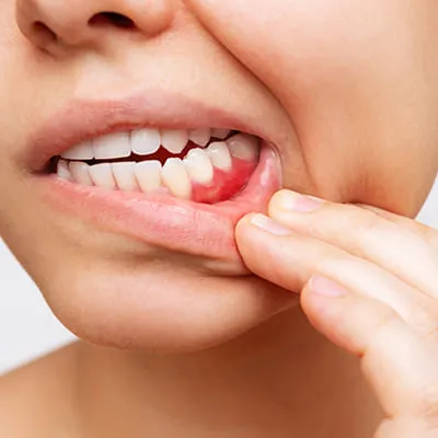 Gum Health