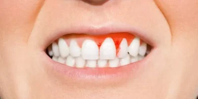 Gum Health