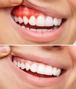 Gum Health