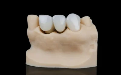 dental bridges