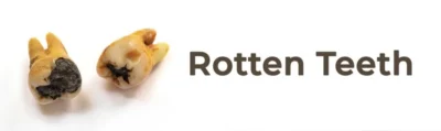 Rotten teeth