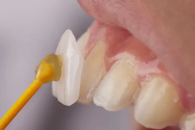 composite veneers