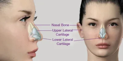 عملية تجميل الأنف 
