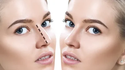 عملية تجميل الأنف