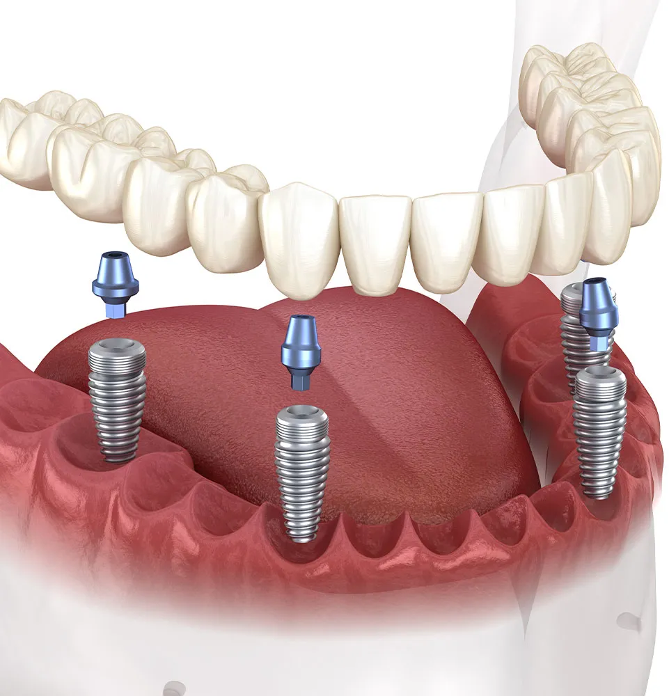 الزرعات السنية